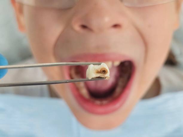 Best Cracked Tooth Emergency Dentist  in Hearne, TX